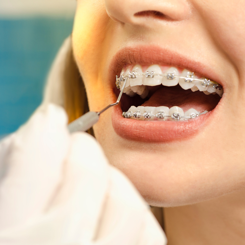 Braces
