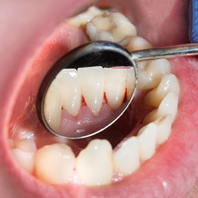 Understanding periodontitis:  the silent gum disease