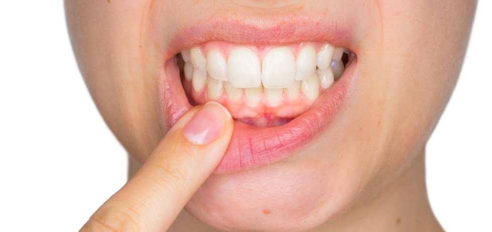 The hidden dangers of gingivitis: how gum health affects your whole body