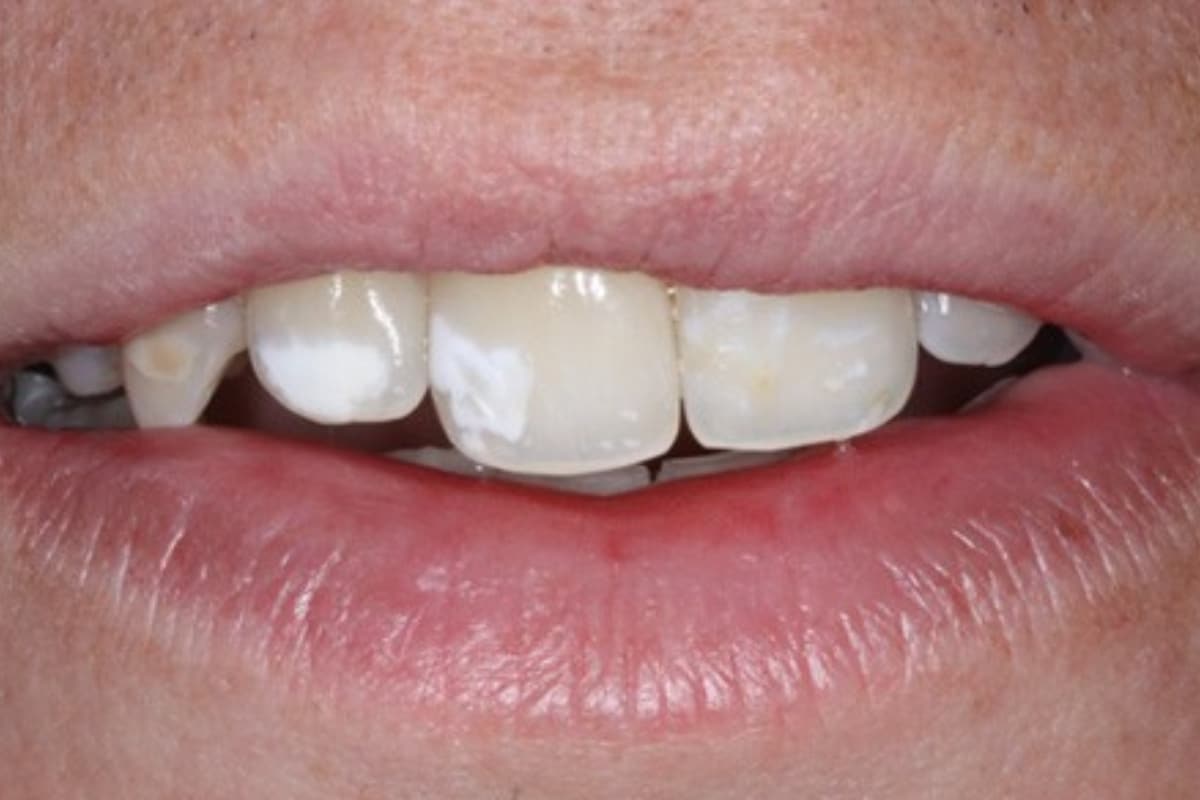 All you need to know about white stains on teeth.