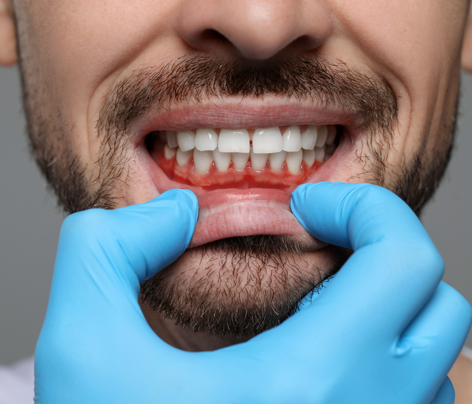 Gingivitis: what it is and how to cure it?